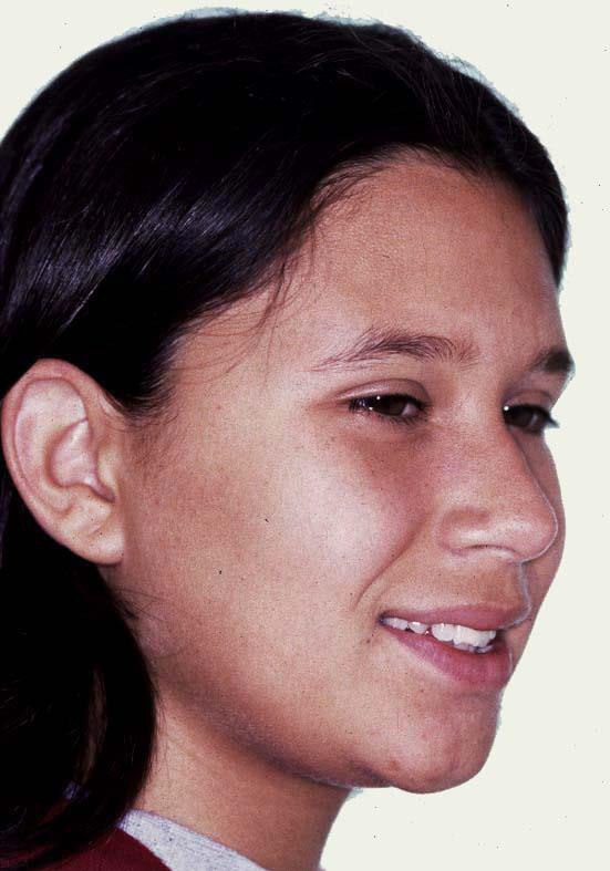 Caso 1 cara después