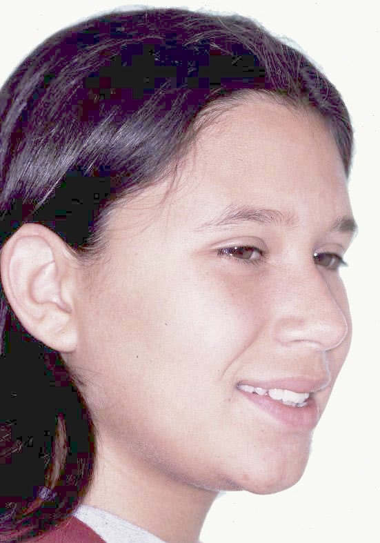 Caso 1 cara después