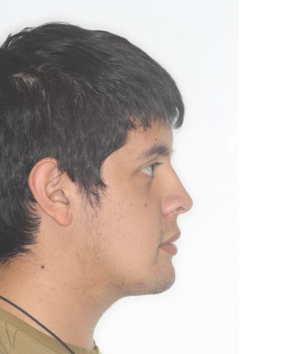 Caso 2 cara después