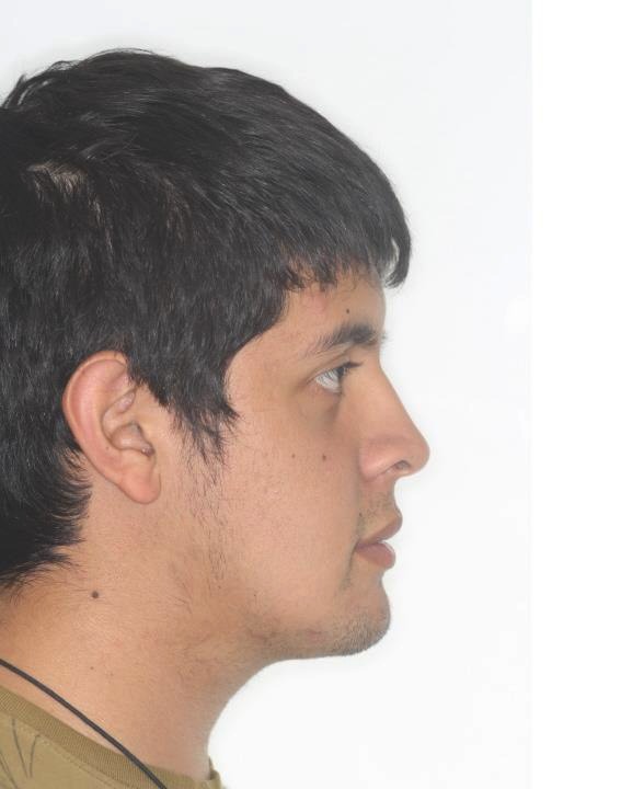 Caso 2 cara después